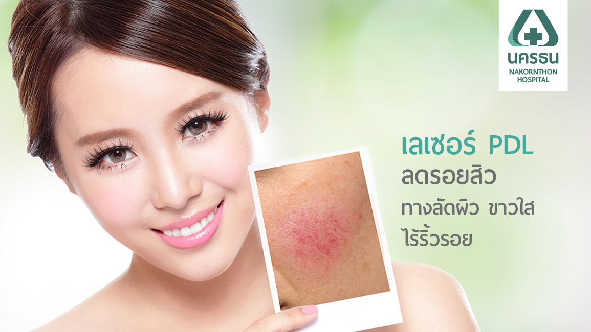 ร่องรอยจากสิว ไม่ใช่เรื่องใหญ่ แก้ด้วยเลเซอร์ PDL ทางลัดผิวอ่อนวัย ขาวใส ไร้ริ้วรอย
